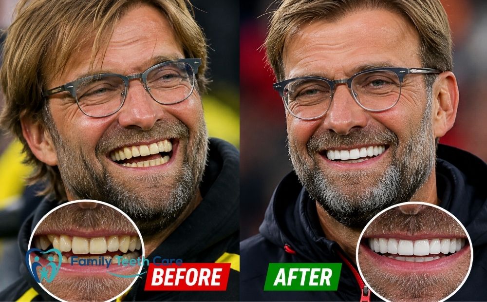 Jurgen Klopp Teeth