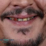 Johnny Depp Teeth