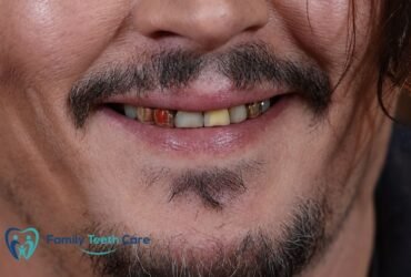 Johnny Depp Teeth