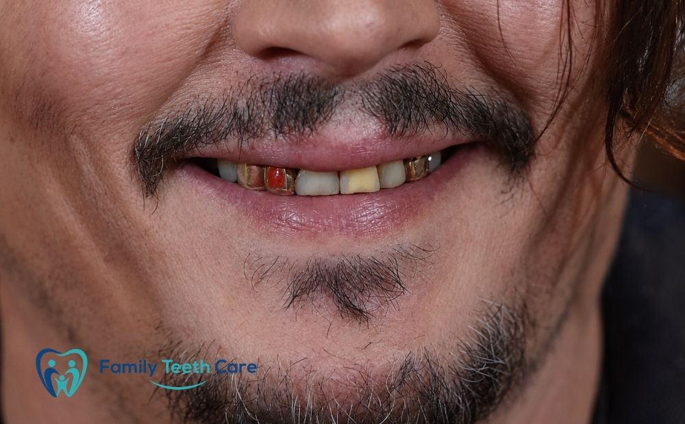 Johnny Depp Teeth